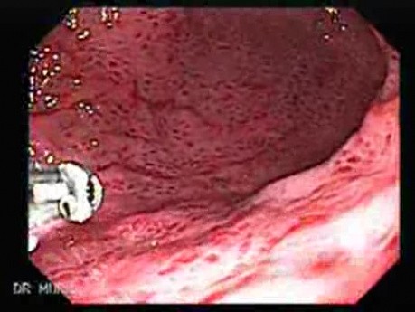 Acute Gastritis (Pangastritis) (8 of 10)