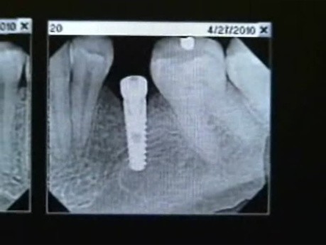 Narrow Diameter Implants