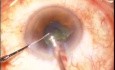 Ozil IP For Post Uveitic Cataract 