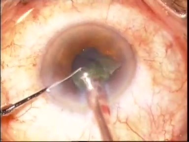 Ozil IP For Post Uveitic Cataract 