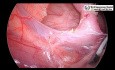 Laparoscopic Appendectomy in Pediatric Patient