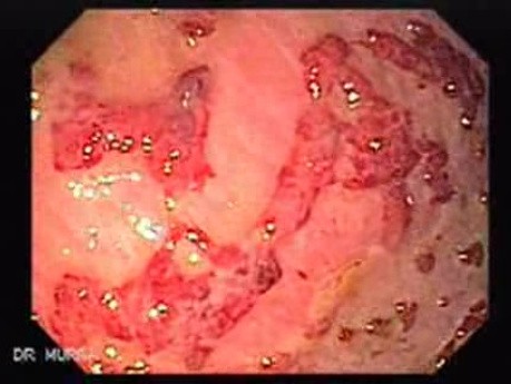 Multiple Rectal Ulcers (21 of 110)