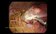 Laparoscopic Liver Biopsy