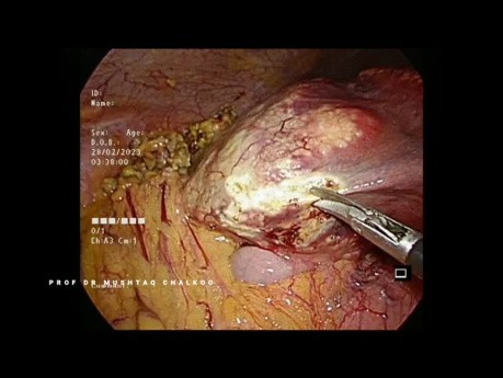 Laparoscopic Liver Biopsy