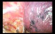 Uniportal VATS Advanced Left Paratracheal, Aortopulmonary, Prevascular Lymphadenectomy (Non Edited)
