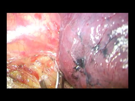 Uniportal VATS Advanced Left Paratracheal, Aortopulmonary, Prevascular Lymphadenectomy (Non Edited)