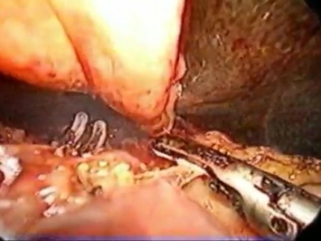 Pancreaticoduodenoctomy - part 3/3