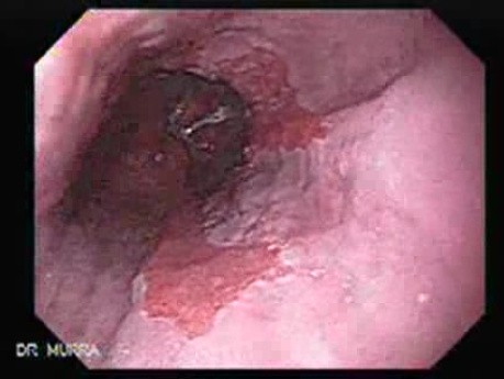 Barrett's Esophagus of long segment (1 of 11)