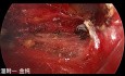 Dual-port Trans-subclavian Thyroid Endoscopic Surgery (part1)