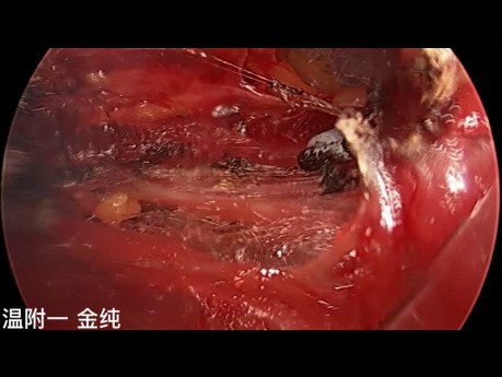 Dual-port Trans-subclavian Thyroid Endoscopic Surgery (part1)