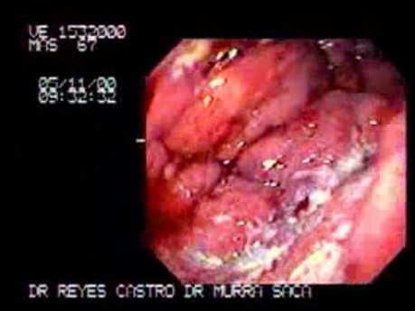 Adenocarcinoma of Stomach