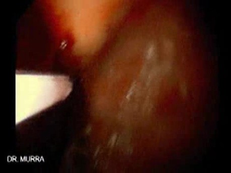 Gastric Varices (14 of 25)