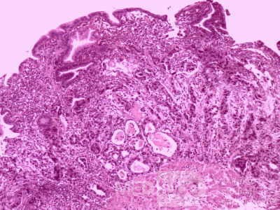 Gallbladder Adenocarcinoma and litiasis (11 of 13)