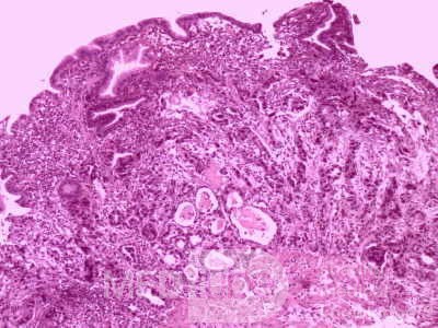 Gallbladder Adenocarcinoma and litiasis (11 of 13)