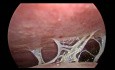 Carcinosis - Gastric Adenocarcinoma