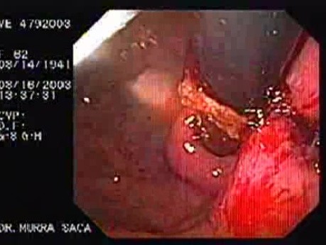 Intraluminal Endoscopic Suturing - Endoscopic Assessment of the Gastric Fundus in the Final Stage of the Procedure