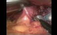Adjustable gastric band removal - laparoscopic method