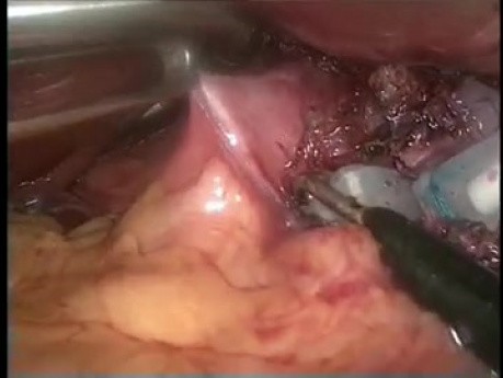 Adjustable gastric band removal - laparoscopic method