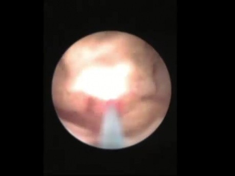 Extracorporal Shock Wave Lithotripsy - Steinstrasse