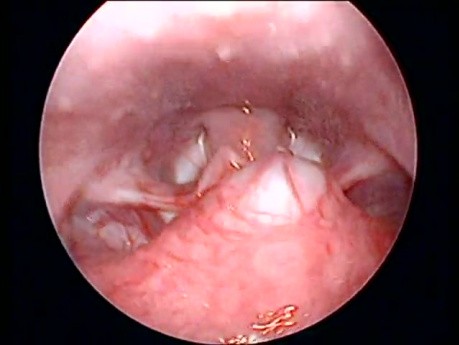 Tongue base mass with prominent overlying vessels