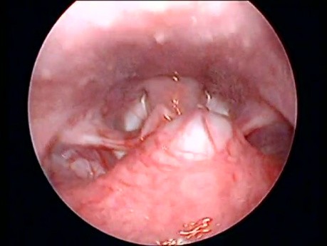 Tongue base mass with prominent overlying vessels