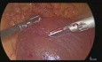 Laparoscopic Excision of a Large Mesothelial Cyst at DJ Flexure