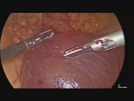 Laparoscopic Excision of a Large Mesothelial Cyst at DJ Flexure