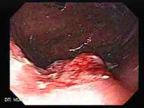 Early Gastric Cancer - Endoscopy (2 of 21)