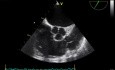 Transesophageal Echocardiography,  Observation of Pulmonary Valve