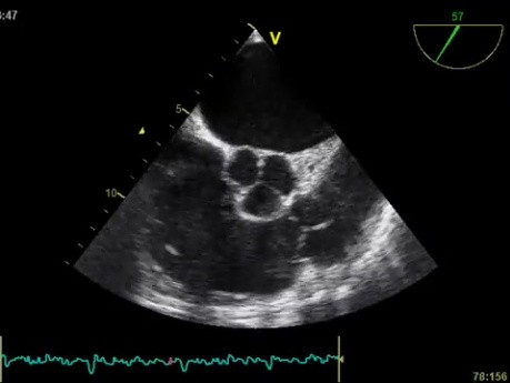 Transesophageal Echocardiography,  Observation of Pulmonary Valve