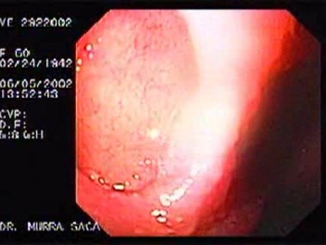 Duodenal Ulcer and Pseudodiverticula