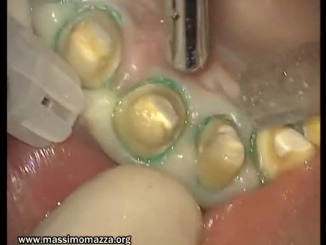 Finishing Preparations - Prosthetic Rehabilitation (2/3)