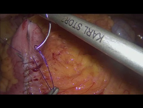 Intracorporeal Ileotransversostomy s-t-s in Laparoscopic Right Hemicolectomy with ICG Perfusion Test