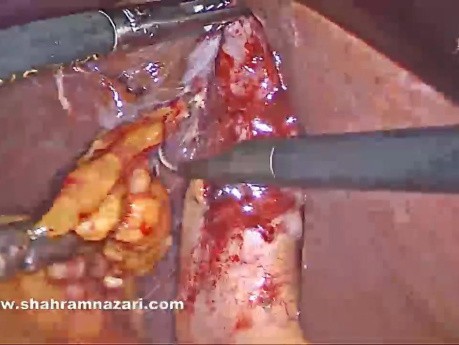 Arterial Dissection in a Case of Chronic Fibrotic Gallbladder
