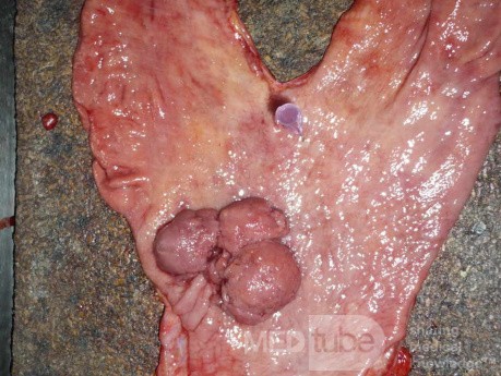Polypoid Adenocarcinoma (3 of 9)