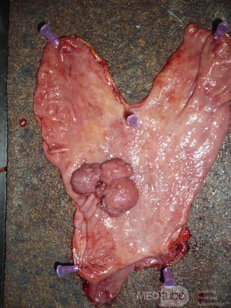 Polypoid Adenocarcinoma (3 of 9)
