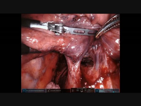 Lung Cancer of the Lower Lobe - Robotic Pneumonectomy