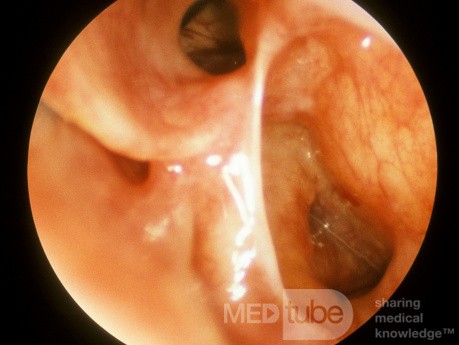 Postoperative Frontal Sinus Recess