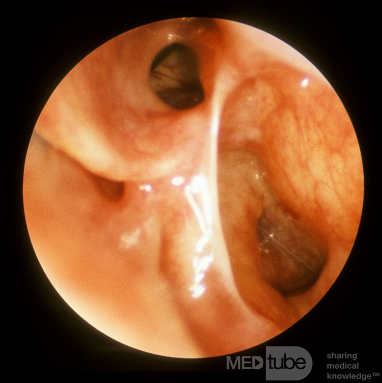 Postoperative Frontal Sinus Recess