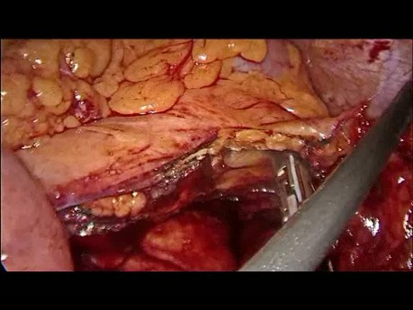 Upper Segmental Colectomy