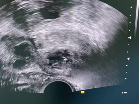 Drainage Prostate Abscess Under Ultrasound