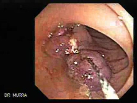 Stalked Polyp - Polypectomy (3 of 6)