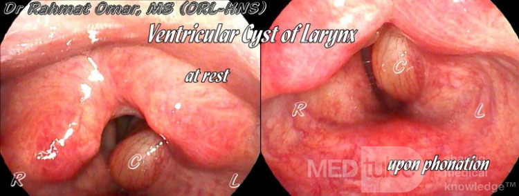 Ventricular Cyst At Rest & Phonation Labelled