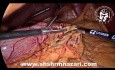 Concomitant Sleeve Gastrectomy and Laparoscopic Cholecystectomy
