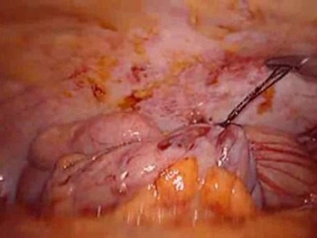 Colonic Perforation With Peritonitis - Laparoscopy (21 of 46)