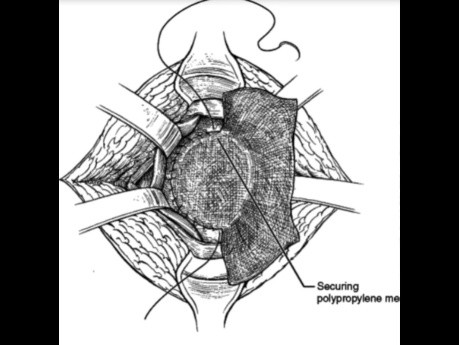 Umblical Hernia Repair