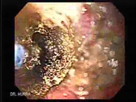 Adenocarcinoma of the Gastroesophageal Junction - Recanalization of the Lumen by Use of Balloon Dilation and Argon Plasma Coagulator