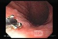 Gastric Cancer - Intestinal Metaplasia - Endoscopy (6 of 7)