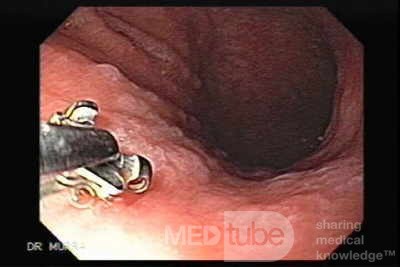 Gastric Cancer - Intestinal Metaplasia - Endoscopy (6 of 7)