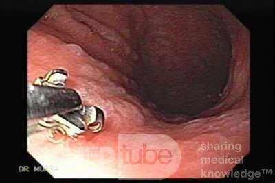 Gastric Cancer - Intestinal Metaplasia - Endoscopy (6 of 7)